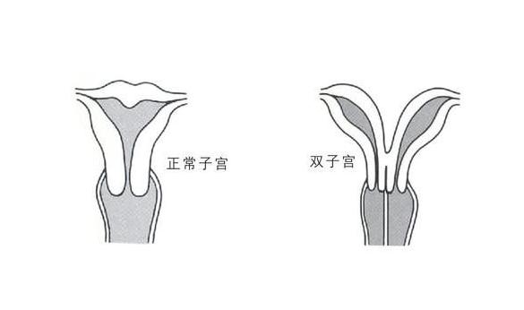 <b>双子宫”邂逅腺肌症怎么办？</b>