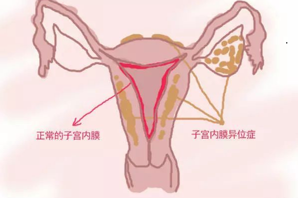 <b>子宫内膜异位症的原因和表现形式有哪些？</b>