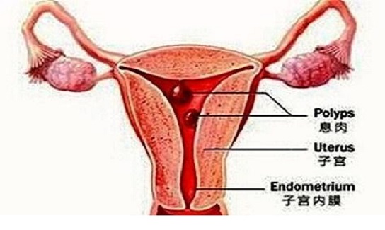 <b>子宫内膜息肉影响怀孕吗？</b>