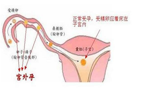 <b>女性应该怎样警惕宫外孕？</b>