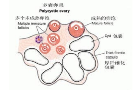 <b>多囊卵巢怎样确诊？有哪些检查？</b>