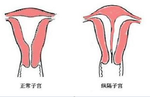 <b>子宫纵隔到底是怎么回事？</b>