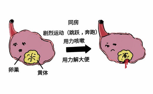 <b>黄体破裂的原因有哪些？</b>