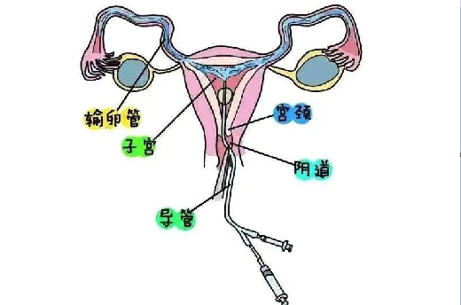 <b>输卵管堵塞做通水有用吗？</b>