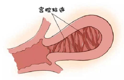 <b>宫腔粘连做试管的成功率有多少？</b>