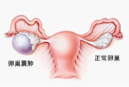 <b>卵巢囊肿是怎样影响你的好“孕”气的？</b>