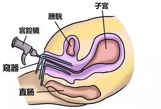 <b>做试管婴儿需要宫腔镜检查吗？</b>