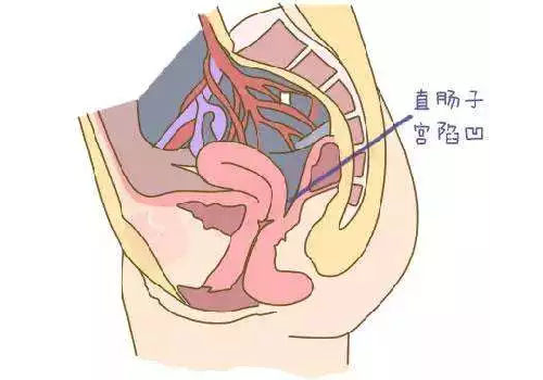 <b>每个人都有“盆腔积液”？</b>