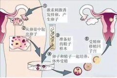 试管婴儿的具体步骤是怎么样