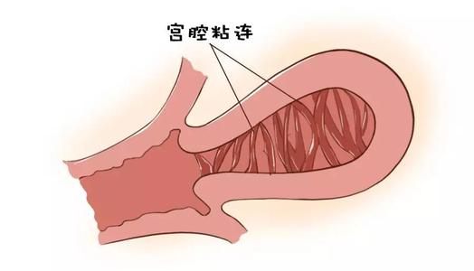 <b>宫腔粘连怀孕难不难？</b>