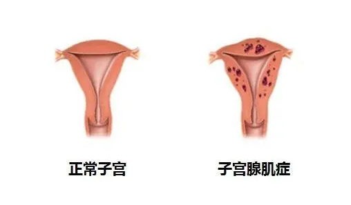 <b>子宫肌腺症怎么治疗 子宫肌腺症可以怀孕吗</b>