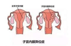 <b>什么是子宫内膜异位，它有哪些影响？</b>