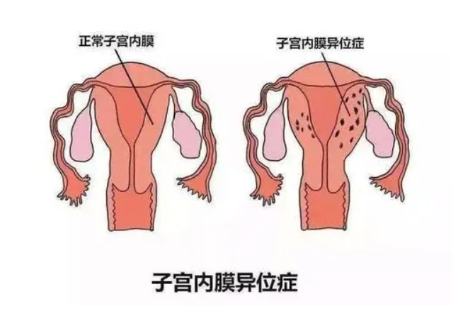 了解子宫内膜异位 子宫内膜异位是怎么发生的