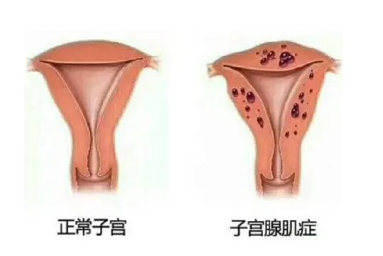 子宫腺肌症的危害 子宫腺肌症回影响怀孕吗？