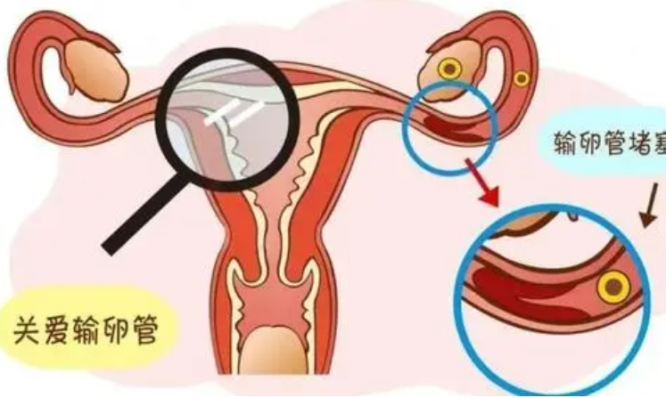 输卵管堵塞的原因，这几个方面要好好排查