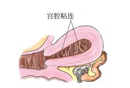 为什么说宫腔粘连是备孕女性的噩梦？