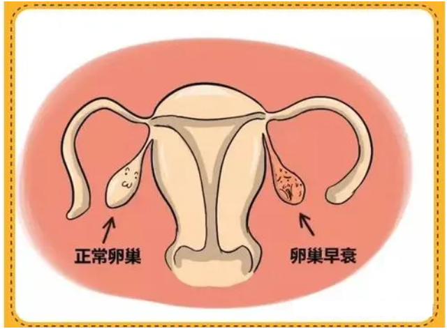 卵巢早衰还能恢复吗 卵巢早衰想怀孕可以吗？