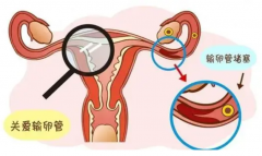 <b>输卵管堵塞怎么生育？输卵管切除生孩子</b>