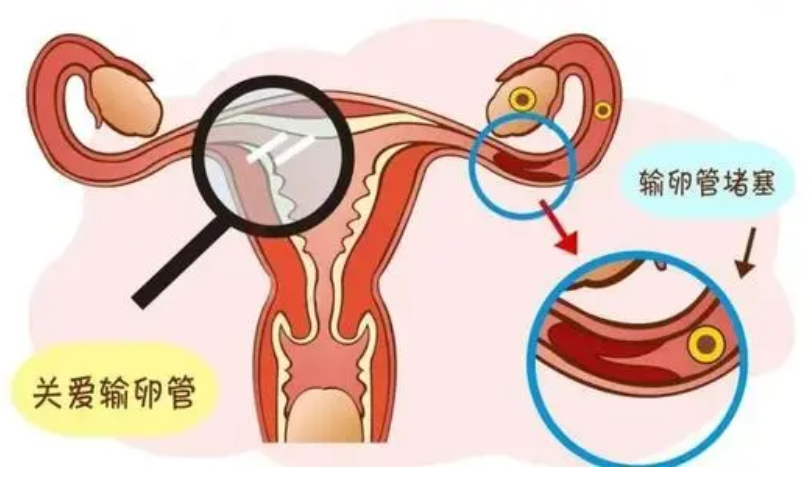 输卵管堵塞怎么生育？输卵管切除生孩子