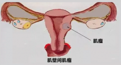 <b>子宫肌瘤可以做试管吗 子宫肌瘤影不影响试管</b>