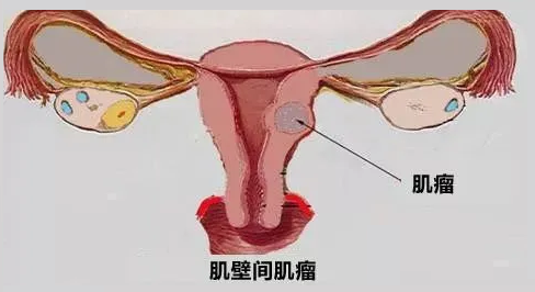 子宫肌瘤可以做试管吗 子宫肌瘤影不影响试管