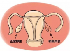 <b>卵巢衰退可以治疗吗 卵巢早衰能治好吗？</b>