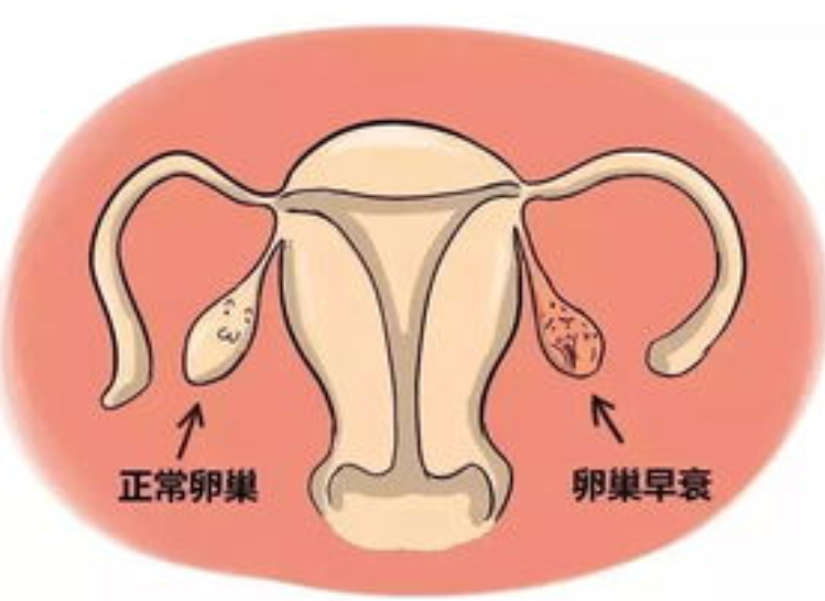 卵巢衰退可以治疗吗 卵巢早衰能治好吗？