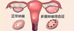 <b>多囊的危害 多囊卵巢综合征就代表不孕？</b>