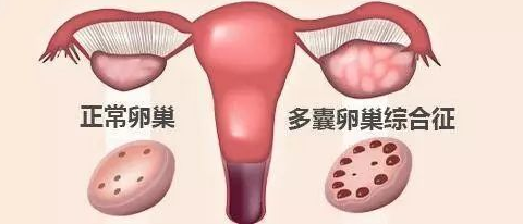 多囊的危害 多囊卵巢综合征就代表不孕？