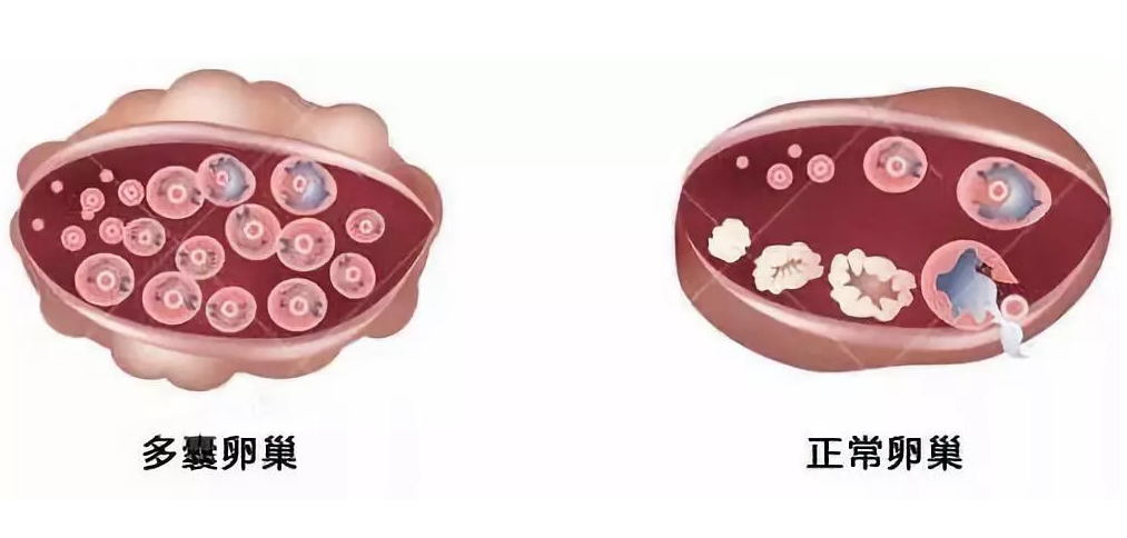 多囊的危害 多囊卵巢综合征就代表不孕？