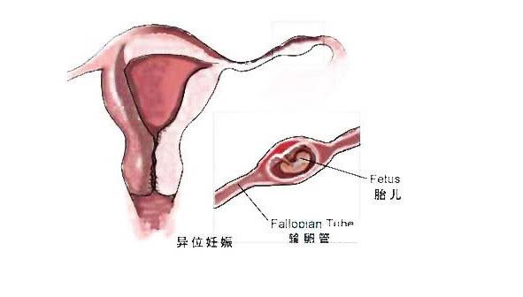 试管婴儿也会发生宫外孕吗 宫外孕的危害