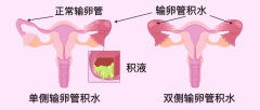 <b>输卵管积水“有毒”，会降低试管婴儿成功率</b>