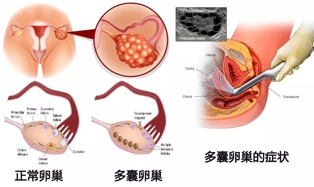 卵巢里卵泡多以后就会发展成多囊吗？