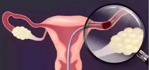 输卵管积液会影响胚胎着床吗?